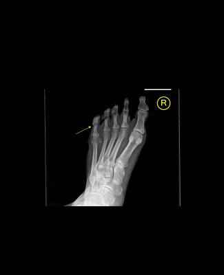 Cracked on sale toe bone