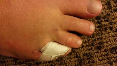 Chiropractic Kingston WA Healing Foot Taped